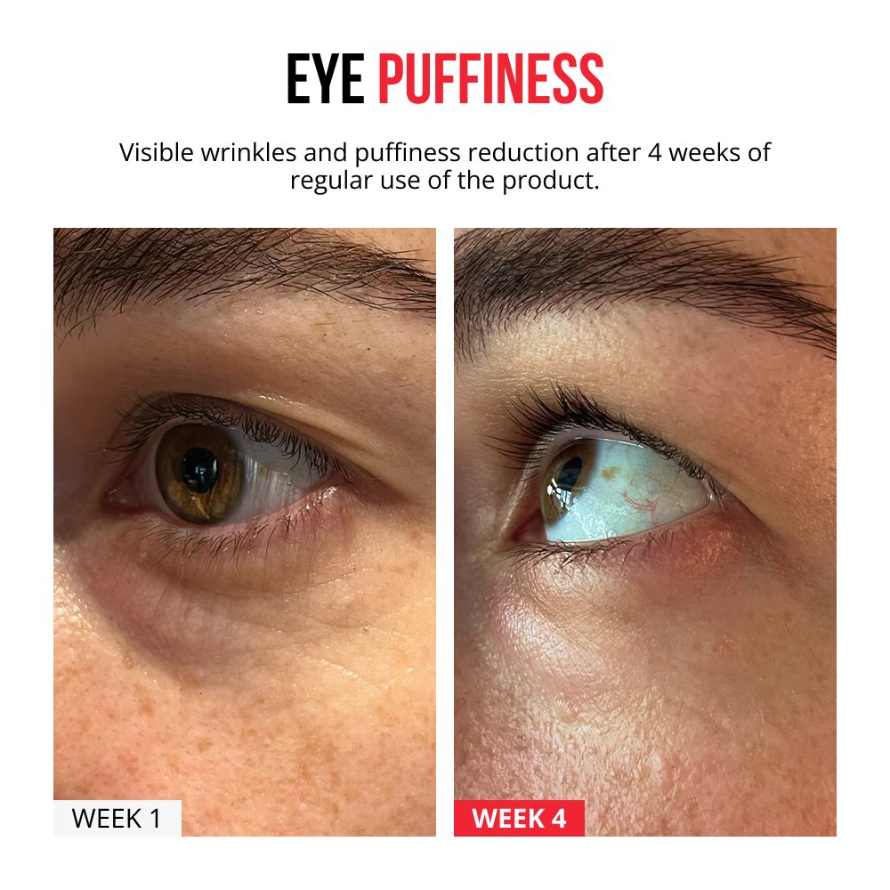 Self-dissolving Microneedle Patches